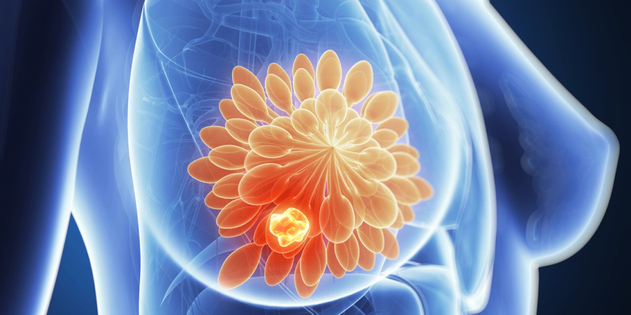 Kadınlarda Sık Görülen Kanser Türleri Nelerdir ?